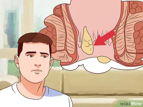 Image titled Tell Signs of Sexual Infection from Penis Step 19