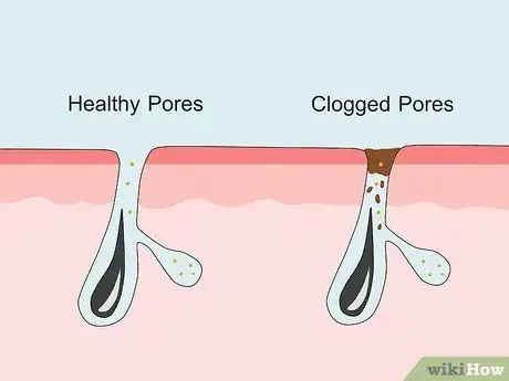 Image titled Clean Clogged Pores Step 1