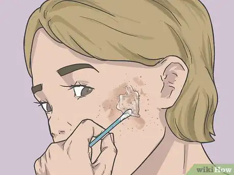 Image titled Bleach Skin with Peroxide Step 10