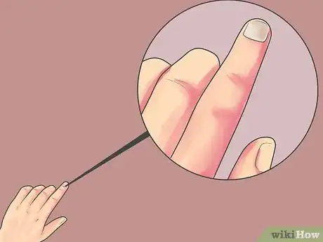 Image titled Know if You Have Nail Fungus Step 3