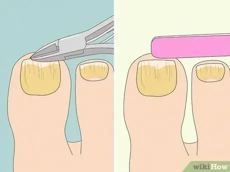 Image titled Get Rid of Yellow Toenails Step 2