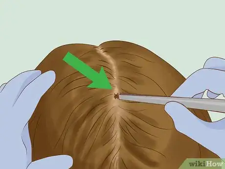 Image titled Get Rid of Ticks in Your Hair Step 1