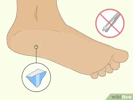 Image titled Get Glass out of Your Foot Step 8
