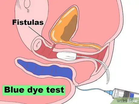 Image titled Diagnose a Fistula Step 11