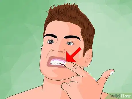 Image titled Ease Wisdom Tooth Pain Step 1