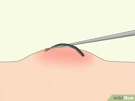 Image titled Remove Deep Ingrown Hairs Step 2