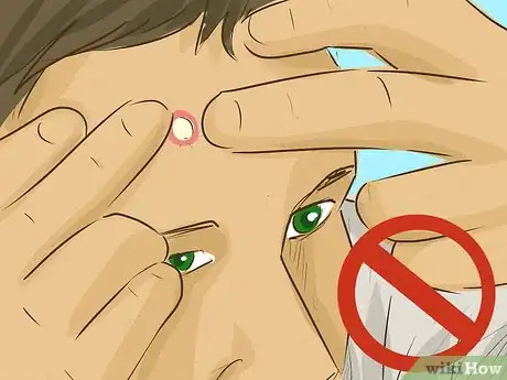 Image titled Remove a Cyst on Your Face Step 2