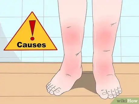Image titled Reduce Leg Swelling Step 7