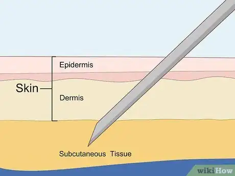 Image titled Troubleshoot a Difficult Venipuncture Step 1