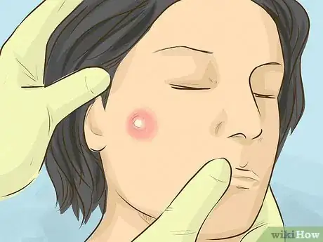 Image titled Remove a Cyst on Your Face Step 3