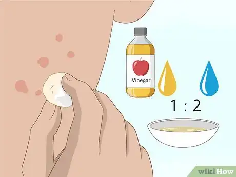 Image titled Get Rid of Acne Scars Fast Step 17