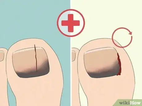 Image titled Treat a Black Toenail Step 4