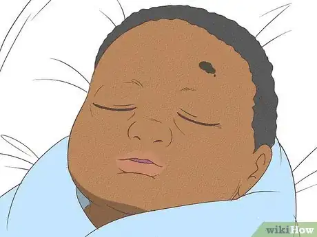 Image titled Know What to Expect on a Newborn's Skin Step 17