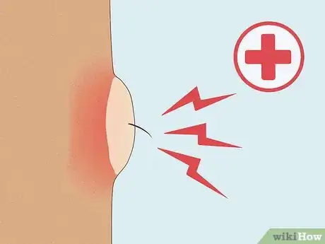 Image titled Remove Deep Ingrown Hairs Step 5