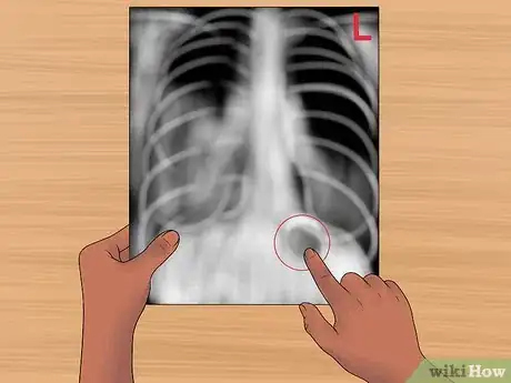 Image titled Read a Chest X Ray Step 11