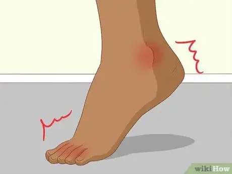 Image titled Recognize Gout Symptoms Step 2
