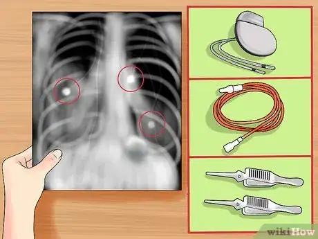 Image titled Read a Chest X Ray Step 13