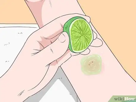 Image titled Stop Mosquito Bites from Itching Step 1