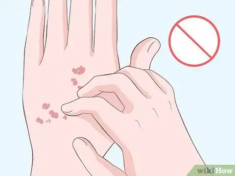 Image titled Heal Scabies Scars Step 14