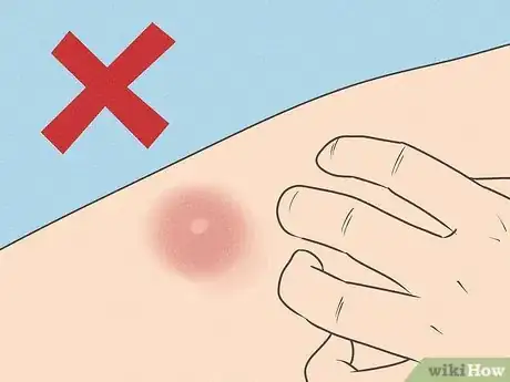 Image titled Get Rid of a Mosquito Bite Step 1