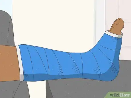 Image titled Treat a Broken Ankle Step 14
