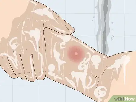 Image titled Get Rid of a Mosquito Bite Step 2