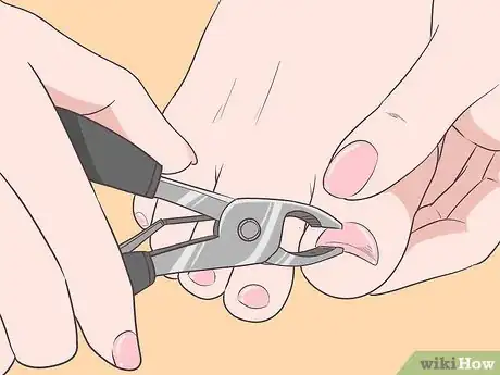 Image titled Fix Thick Toenails Step 2