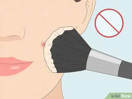 Image titled What to Do After Removing Pimple Patch Step 6