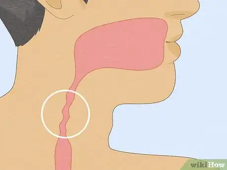 Image titled Clear an Esophageal Blockage Step 3