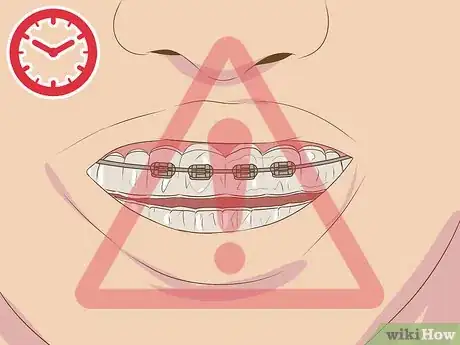 Image titled Make Fake Braces or a Fake Retainer Step 19