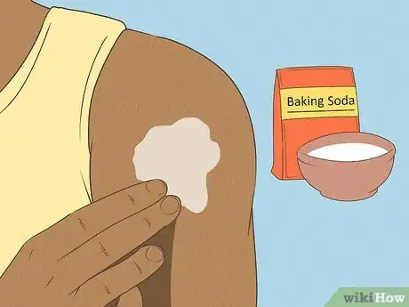 Image titled Get Rid of a Mosquito Bite Step 5