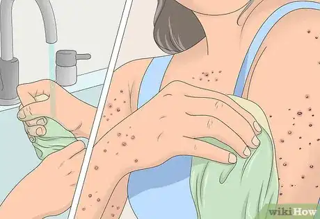 Image titled Prevent Chicken Pox Scars Step 4