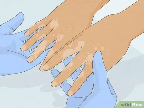 Image titled Get Rid of White Spots on the Skin Due to Sun Poisoning Step 7