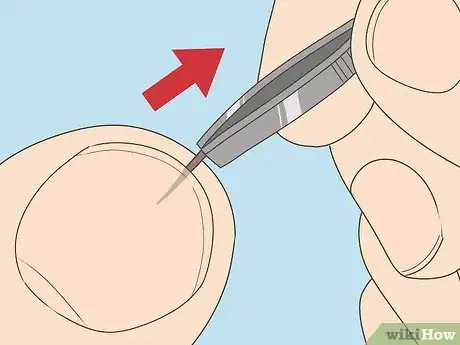 Image titled Remove a Splinter Under Your Fingernail Step 2