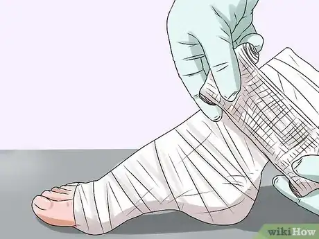Image titled Preserve a Severed Limb Step 8