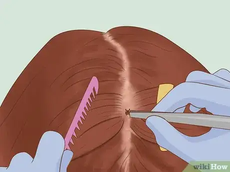 Image titled Get Rid of Ticks in Your Hair Step 5
