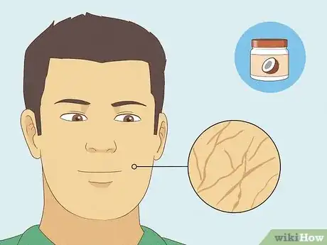 Image titled Use Coconut Oil for Acne Step 14