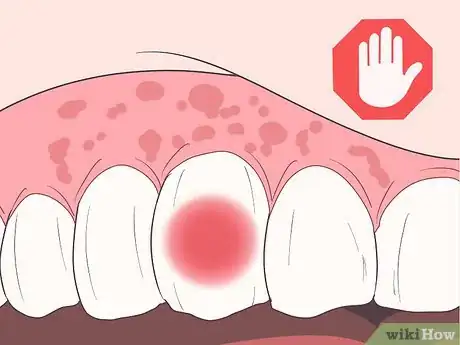 Image titled Stop Toothache Pain Fast Step 16