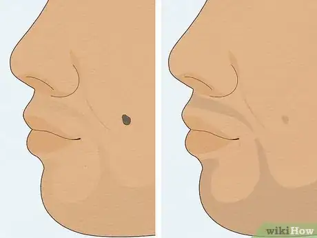 Image titled Remove a Mole with Iodine Step 11