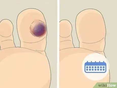 Image titled Treat a Blood Blister Step 6