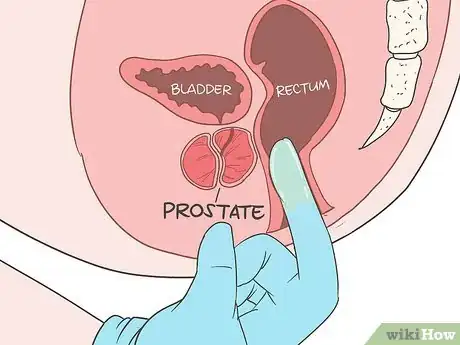 Image titled Locate Your Prostate Step 8