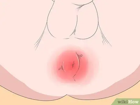 Image titled Prevent Perianal Abscess from Returning Step 14