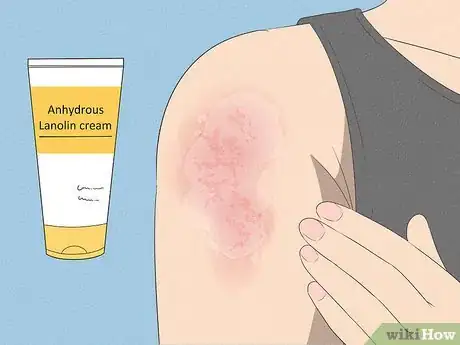 Image titled Prevent Heat Rash Step 12