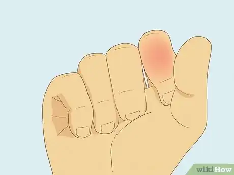 Image titled Know If Your Knuckle Is Broken Step 10