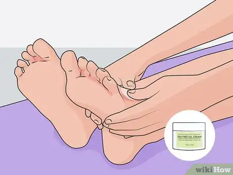 Image titled Get Rid of Foot Fungus at Home Step 06