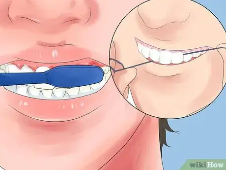 Image titled Alleviate Orthodontic Brace Pain Step 15