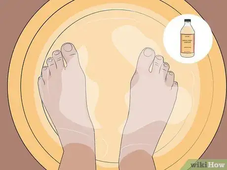 Image titled Get Rid of Foot Fungus at Home Step 08