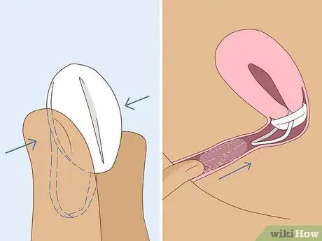 Image titled Use the Birth Control Sponge Step 4