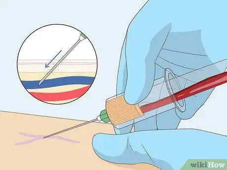 Image titled Troubleshoot a Difficult Venipuncture Step 5