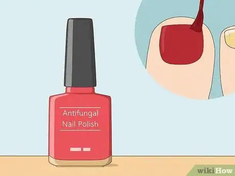 Image titled Get Rid of Yellow Toenails Step 5